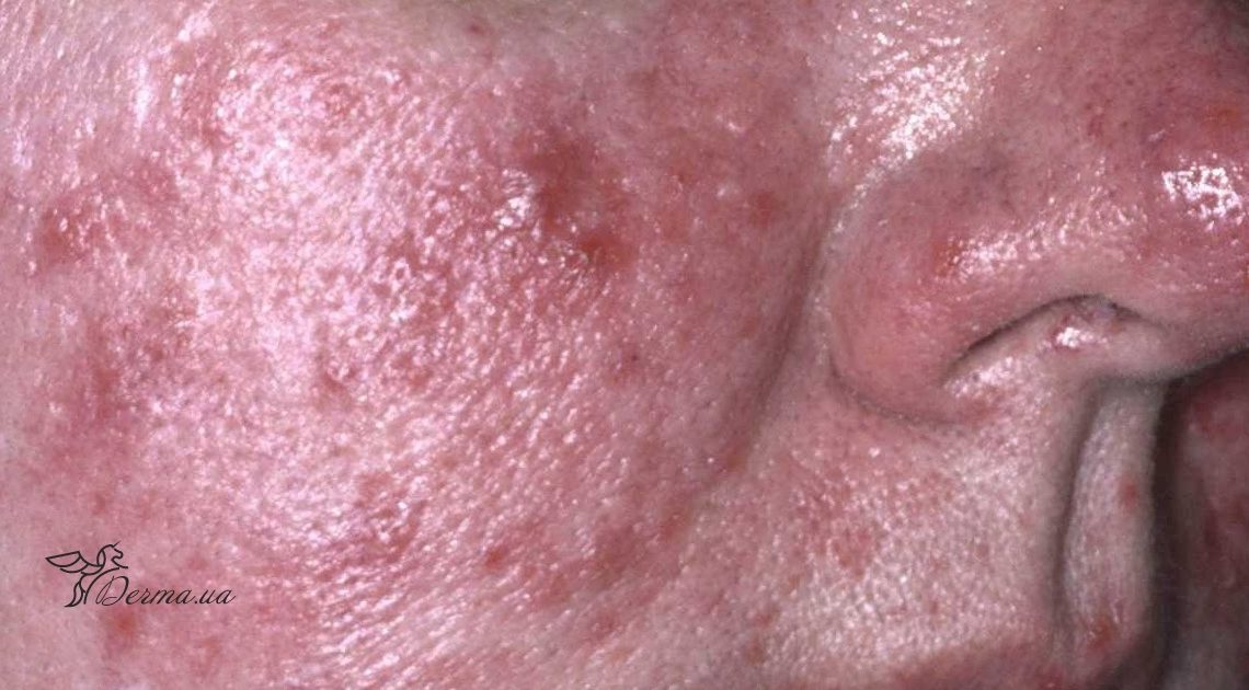 Себорея (Acne vulgaris). Диагностика и лечение | Альтермед
