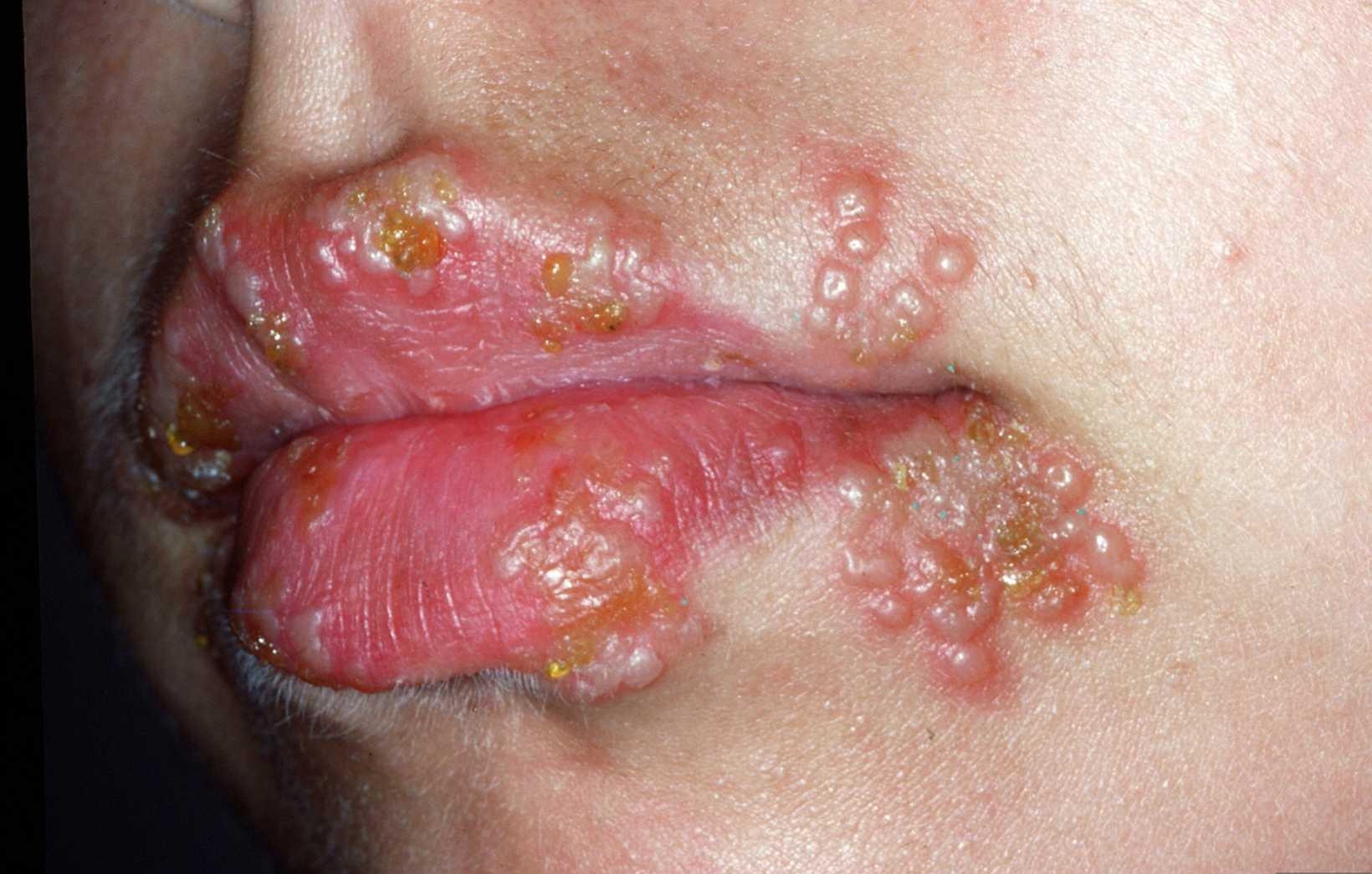 Белые язвы во рту после поцелуев, нужно ли лечить гранулы Фордайса? | консультація онлайн
