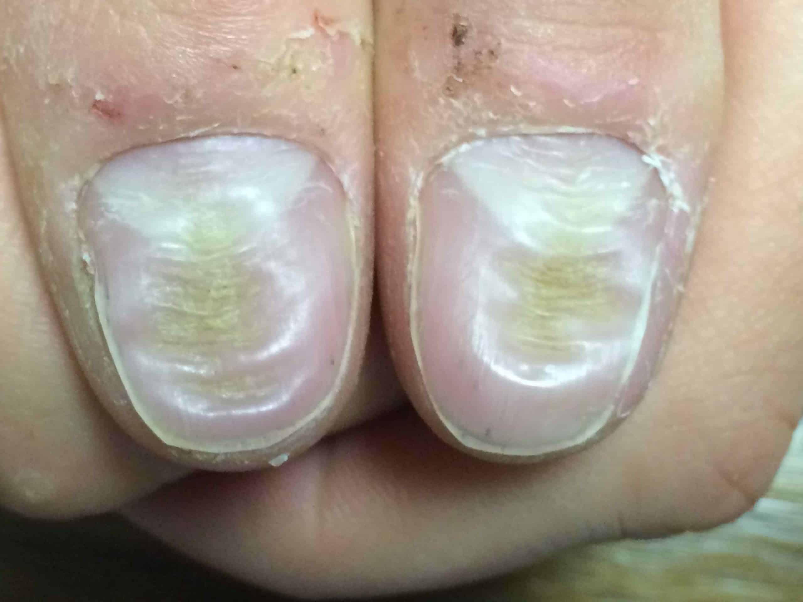Псориаз ногтей : симптомы, причины появления и методы лечения (Тайтл)