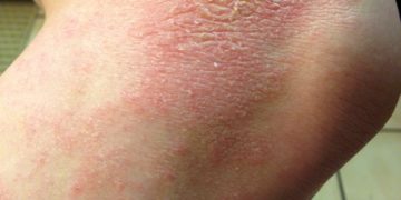 Самые распространенные заболевания кожи у детей