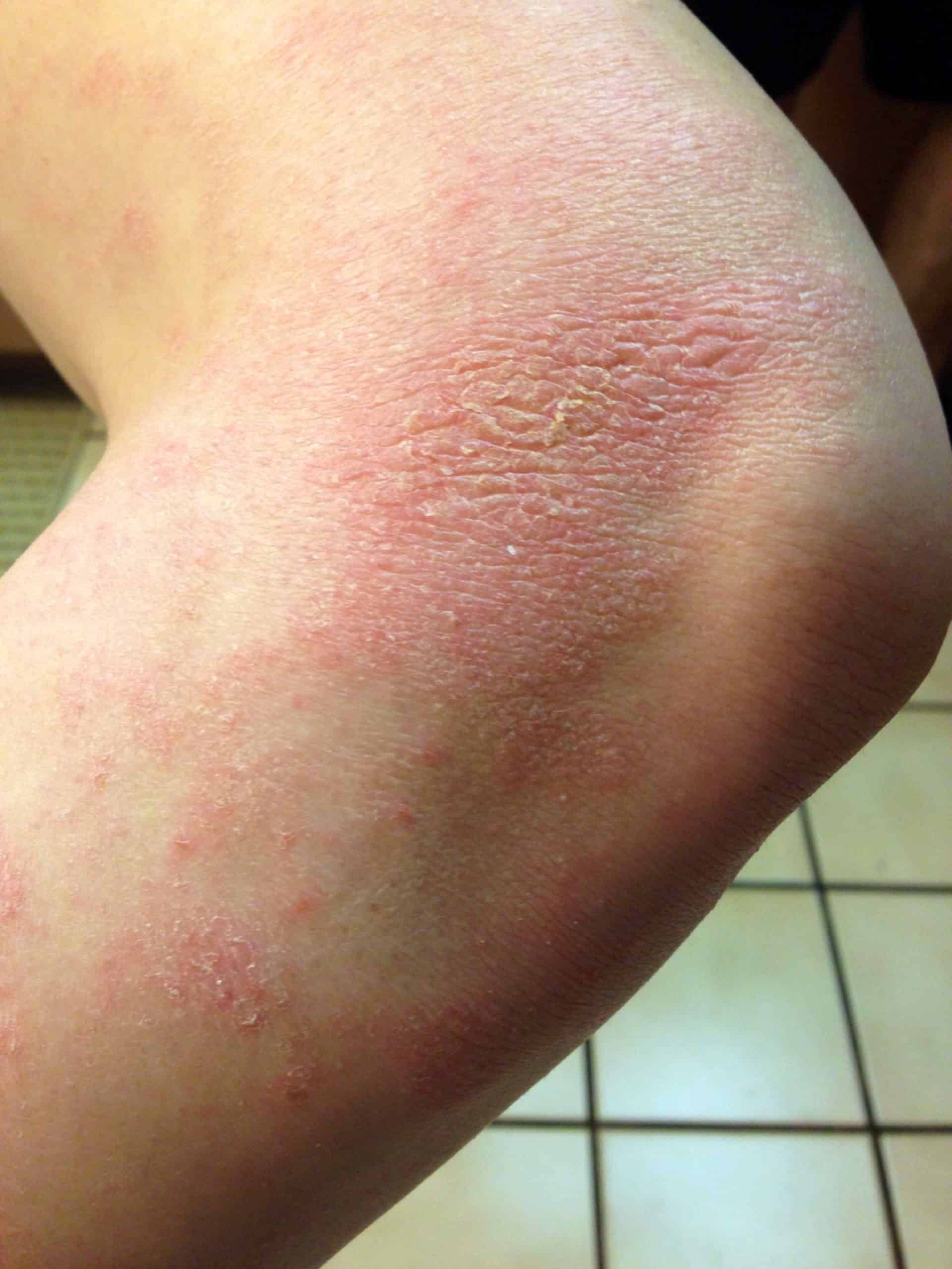 Аллергический дерматит фото у детей на руках